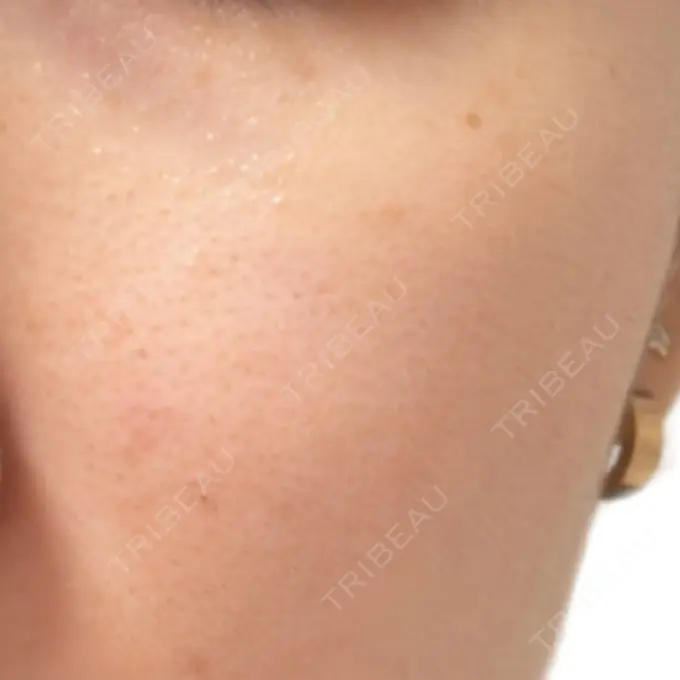 ほくろ・いぼ除去レーザー（肌） Fellez Clinic【フェルズクリニック】 AFTER メイン用