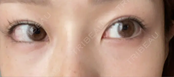 クマ治療 品川美容外科 新宿院（※品川スキンクリニック提携） AFTER メイン用