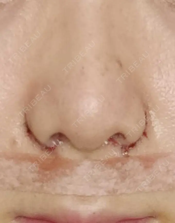 小鼻縮小（切開） 宇都宮ひふ科形成外科 DAY 5 メイン用