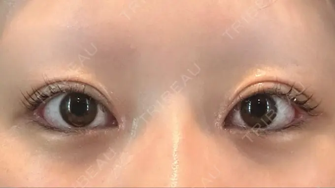 目頭切開 / クマ治療 / 目尻切開 / 下まぶたの脂肪取り / タレ目形成・グラマラスライン（切開） POP美容整形クリニック AFTER メイン用