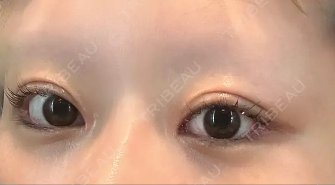 目頭切開 / クマ治療 / 目尻切開 / 下まぶたの脂肪取り / タレ目形成・グラマラスライン（切開） POP美容整形クリニック DAY 32 メイン用