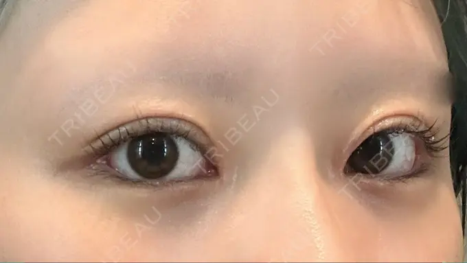 目頭切開 / クマ治療 / 目尻切開 / 下まぶたの脂肪取り / タレ目形成・グラマラスライン（切開） POP美容整形クリニック DAY 32 メイン用