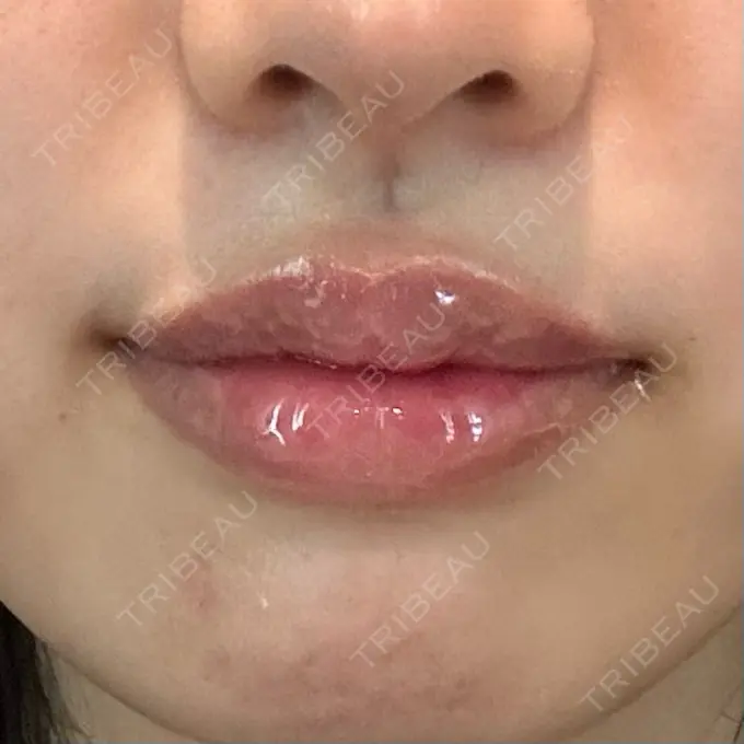 その他（口元） アバント整形外科医院 AFTER メイン用