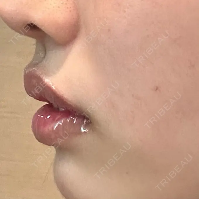 その他（口元） アバント整形外科医院 DAY 26 メイン用