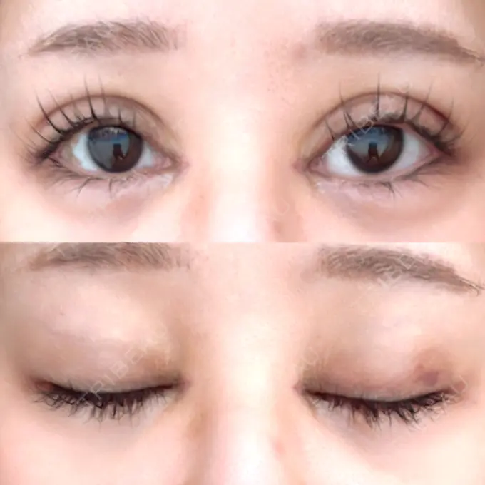 二重埋没 / 目頭切開 Brandnew Beauty Clinic DAY 8 メイン用