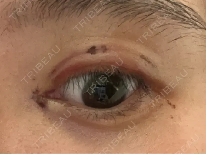 二重埋没 / 目頭切開 アマソラクリニック AFTER メイン用