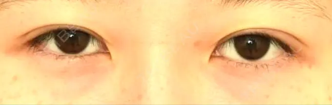 二重埋没 札幌ル・トロワ ビューティクリニックVogue DAY 0 メイン用