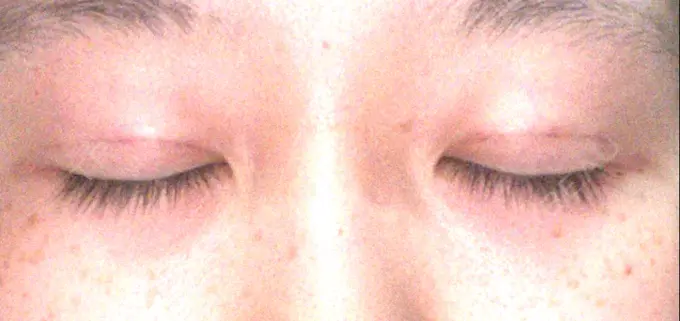 二重埋没 札幌ル・トロワ ビューティクリニックVogue DAY 0 メイン用