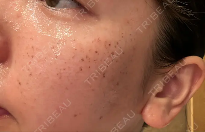 イオン導入 / ルメッカ ルラ美容クリニック 名古屋本院 DAY 1 メイン用