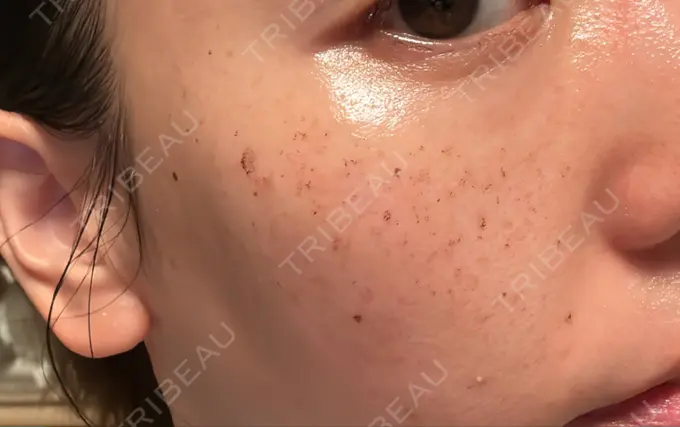 イオン導入 / ルメッカ ルラ美容クリニック 名古屋本院 DAY 2 メイン用