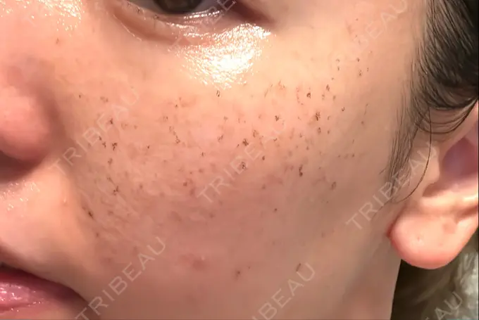 イオン導入 / ルメッカ ルラ美容クリニック 名古屋本院 DAY 2 メイン用