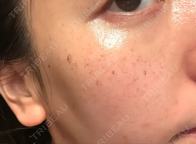 イオン導入 / ルメッカ ルラ美容クリニック 名古屋本院 DAY 3 メイン用