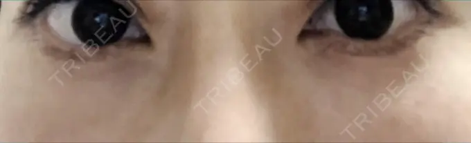 クマ治療 / 下まぶたたるみ取り / 脂肪注入（目の下） 湘南美容クリニック Regno 銀座院 DAY 50 メイン用