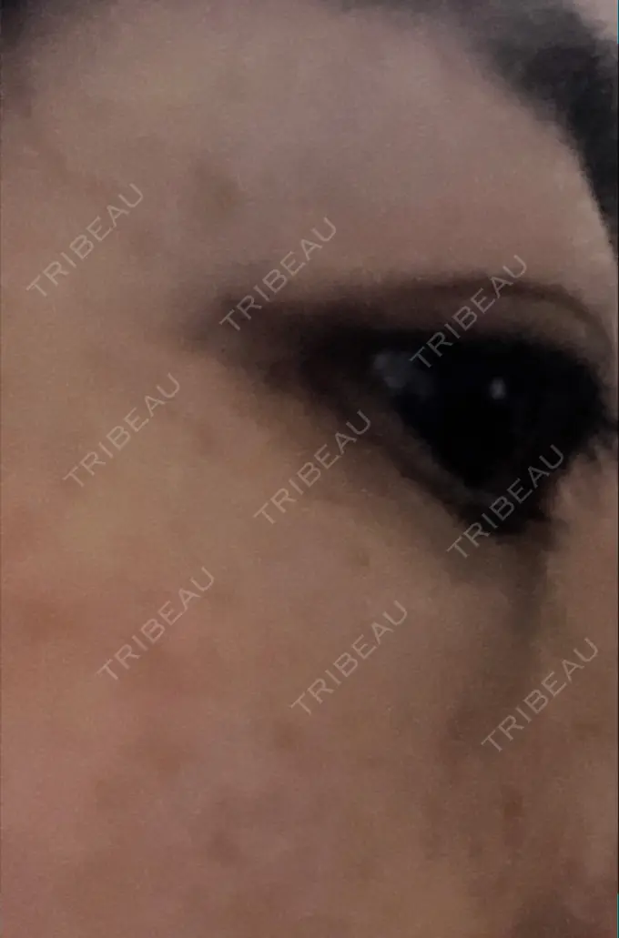 クマ治療 / 下まぶたたるみ取り / 脂肪注入（目の下） 湘南美容クリニック Regno 銀座院 DAY 50 メイン用