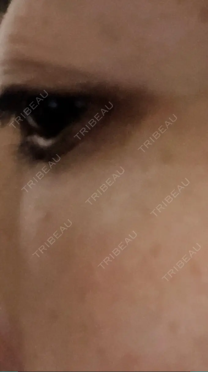 クマ治療 / 下まぶたたるみ取り / 脂肪注入（目の下） 湘南美容クリニック Regno 銀座院 DAY 50 メイン用