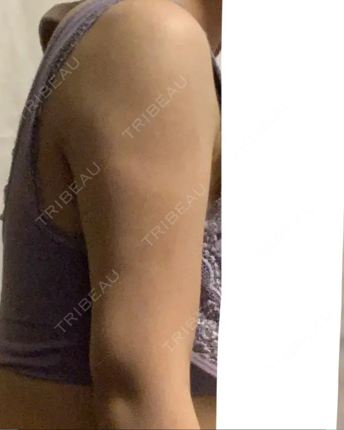 脂肪溶解注射（二の腕） プラデン整形外科 DAY 10 メイン用