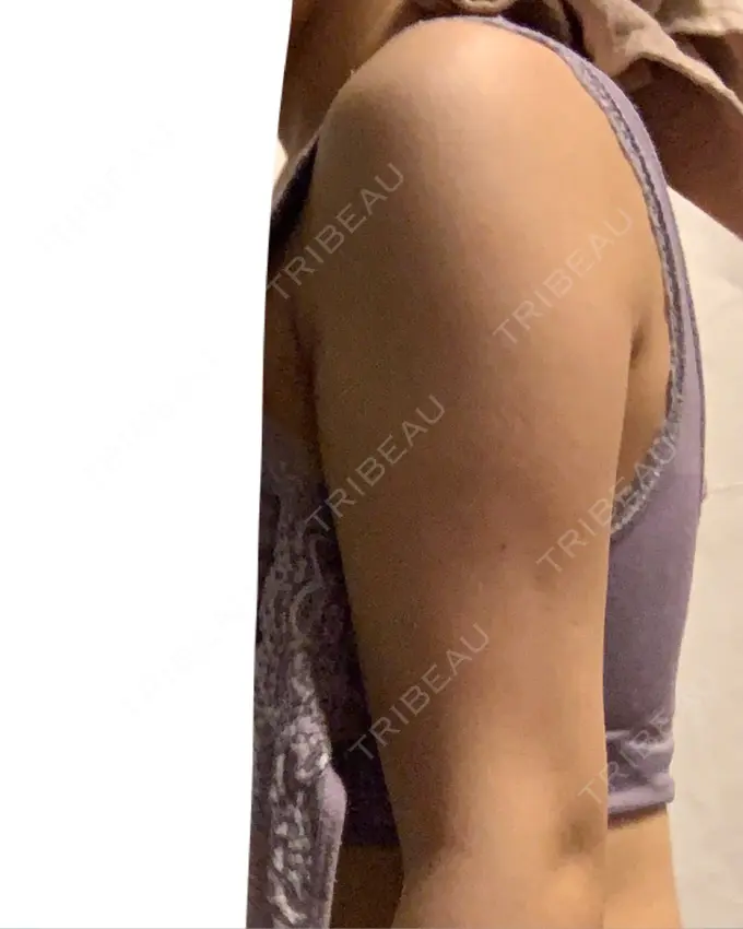 脂肪溶解注射（二の腕） プラデン整形外科 DAY 10 メイン用