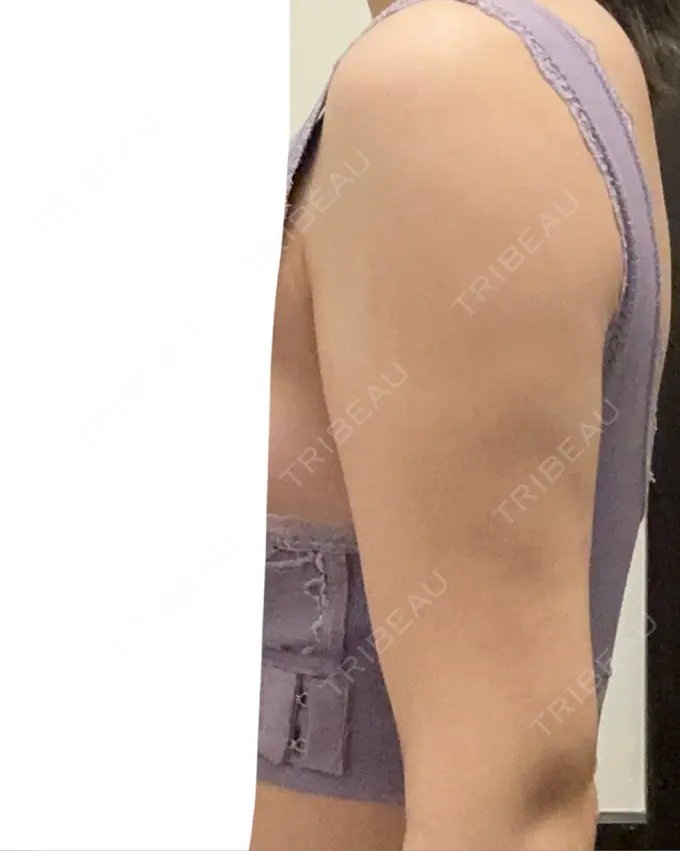 脂肪溶解注射（二の腕） プラデン整形外科 DAY 15 メイン用