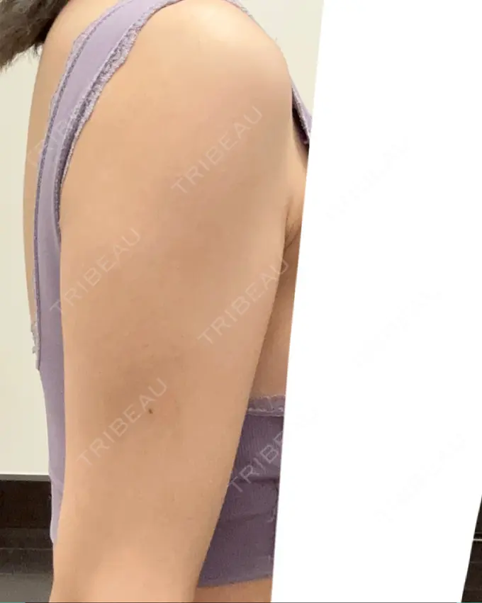 脂肪溶解注射（二の腕） プラデン整形外科 DAY 15 メイン用