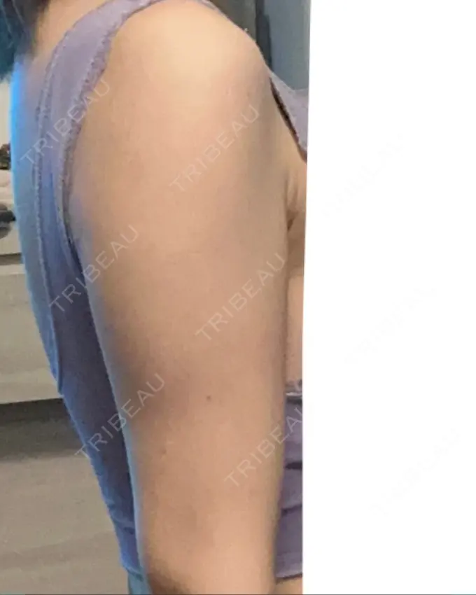 脂肪溶解注射（二の腕） プラデン整形外科 DAY 22 メイン用