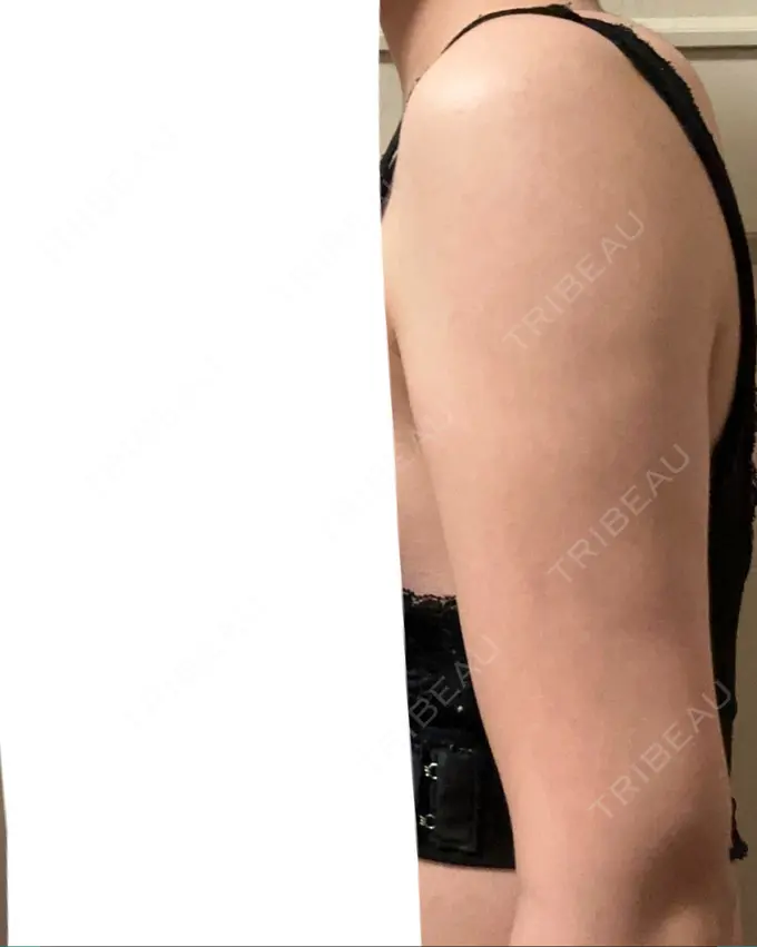 脂肪溶解注射（二の腕） プラデン整形外科 DAY 31 メイン用