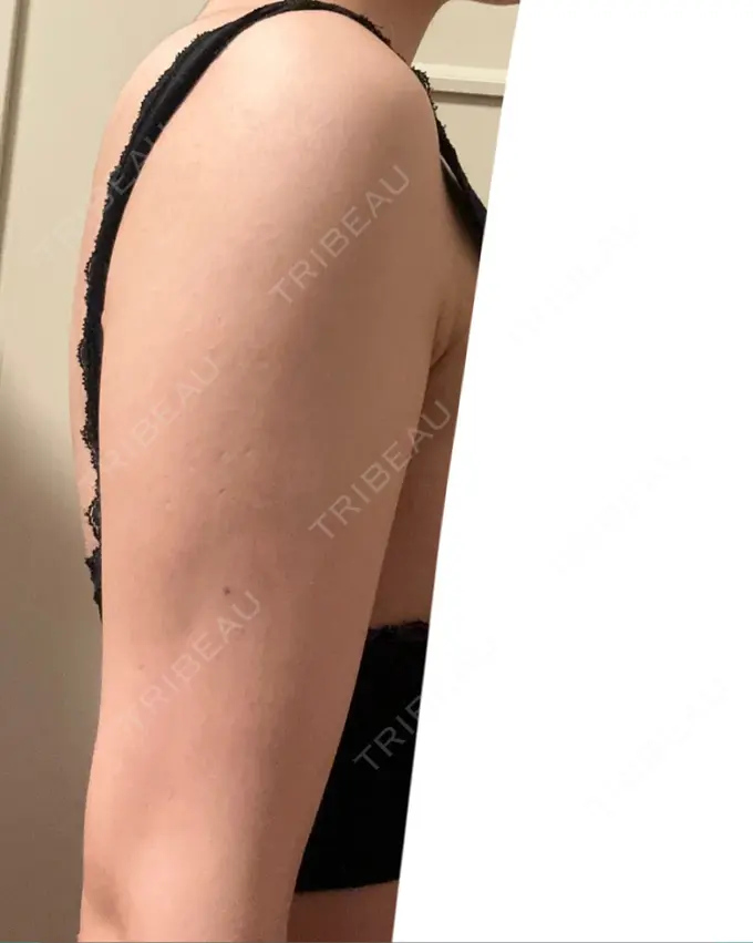 脂肪溶解注射（二の腕） プラデン整形外科 DAY 31 メイン用