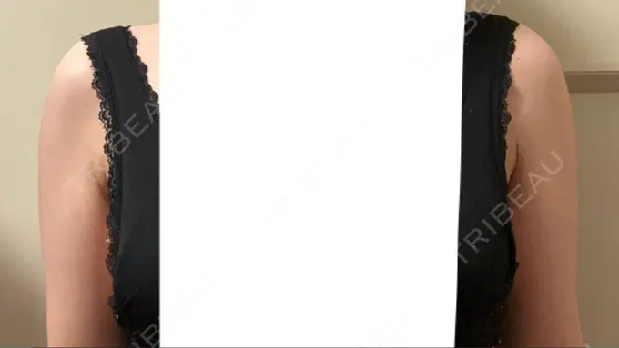 脂肪溶解注射（二の腕） プラデン整形外科 AFTER メイン用