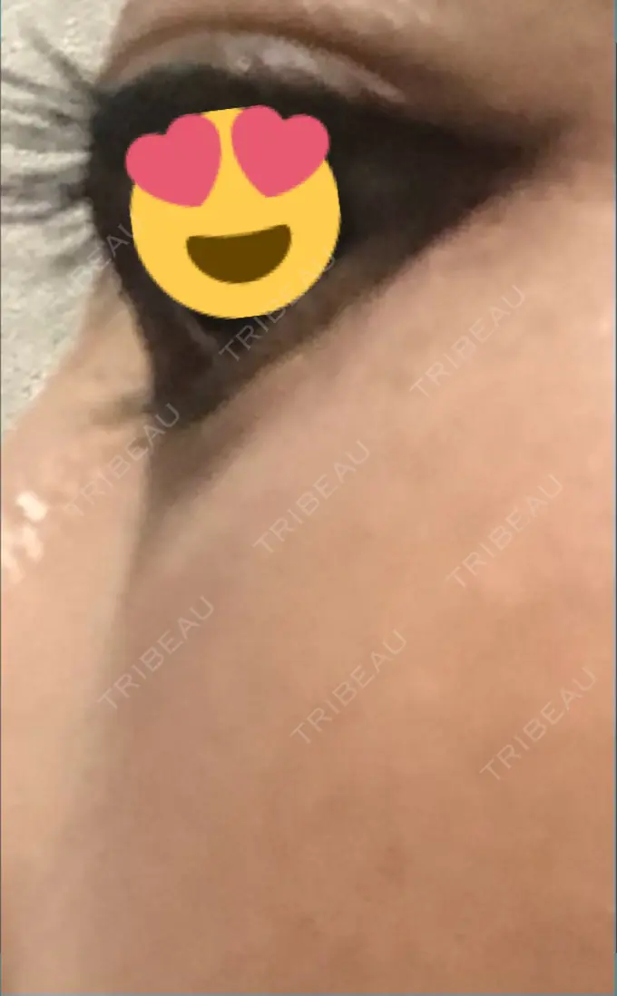 クマ治療 / 下まぶたたるみ取り / 脂肪注入（目の下） 湘南美容クリニック Regno 銀座院 DAY 51 メイン用