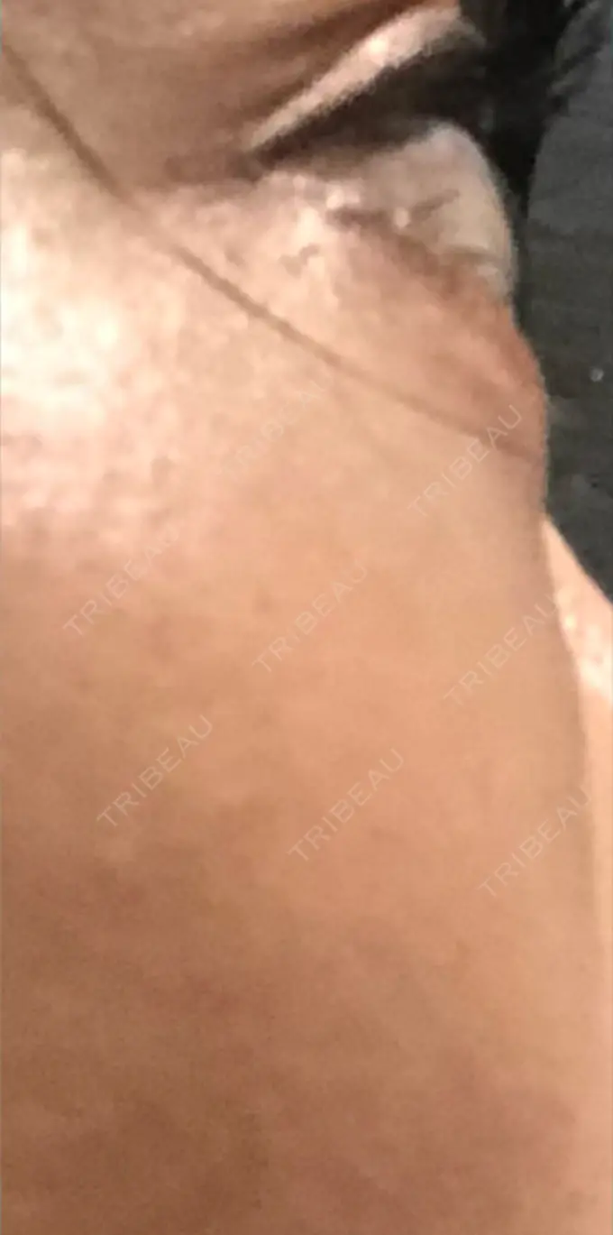 クマ治療 / 下まぶたたるみ取り / 脂肪注入（目の下） 湘南美容クリニック Regno 銀座院 DAY 51 メイン用