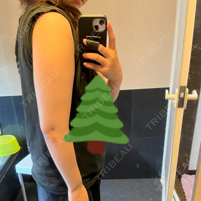 脂肪冷却（二の腕） 湘南美容クリニック 大阪梅田本院 DAY 32 メイン用