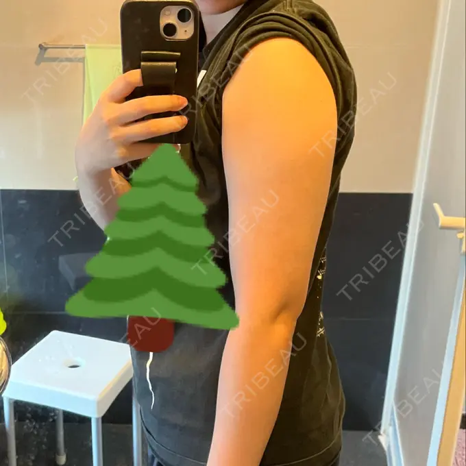 脂肪冷却（二の腕） 湘南美容クリニック 大阪梅田本院 DAY 32 メイン用