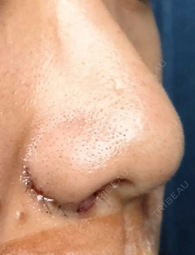 小鼻縮小（切開） 宇都宮ひふ科形成外科 DAY 6 メイン用