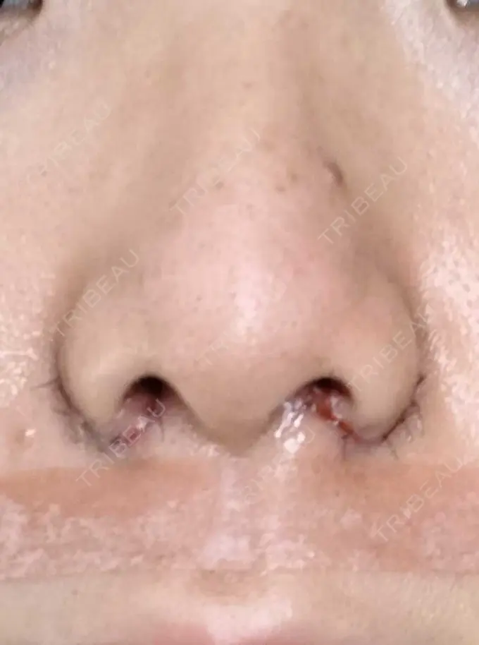 小鼻縮小（切開） 宇都宮ひふ科形成外科 DAY 6 メイン用