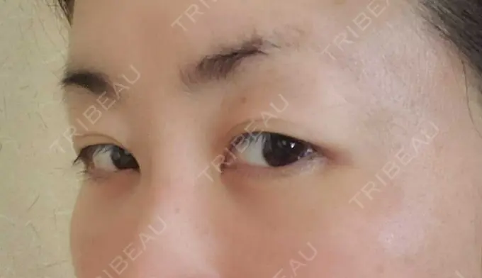 下まぶたたるみ取り / 下まぶたの脂肪取り / その他（目元） エースクリニック 名古屋院 DAY 14 メイン用