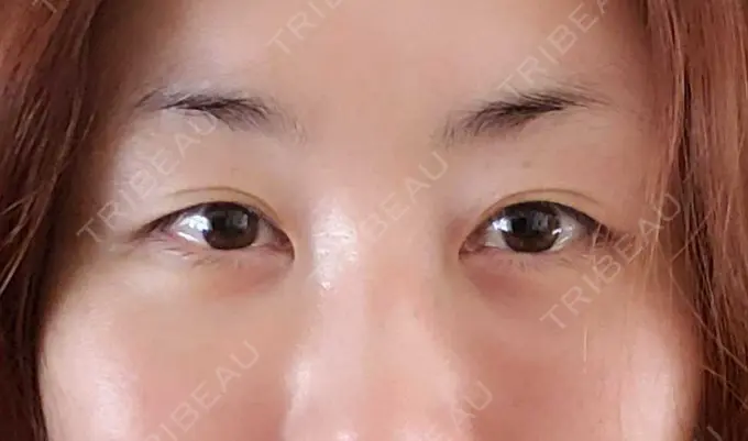 下まぶたたるみ取り / 下まぶたの脂肪取り / その他（目元） エースクリニック 名古屋院 DAY 14 メイン用