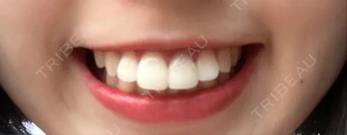 セラミック オーラルビューティークリニック クラリス審美歯科・矯正歯科 AFTER メイン用