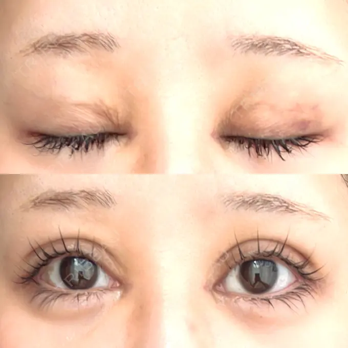 二重埋没 / 目頭切開 Brandnew Beauty Clinic DAY 9 メイン用