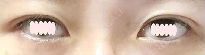 二重埋没 札幌ル・トロワ ビューティクリニックVogue DAY 1 メイン用