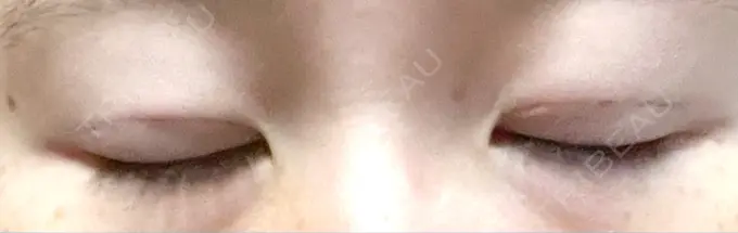 二重埋没 札幌ル・トロワ ビューティクリニックVogue DAY 1 メイン用