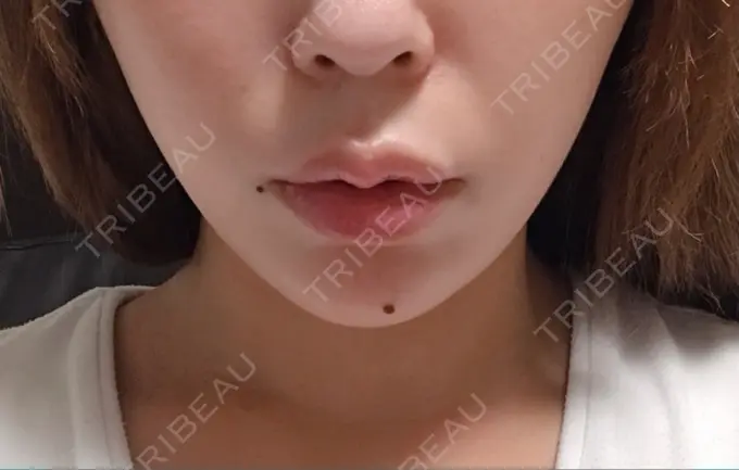 ボトックス（あご） / ヒアルロン酸注入（あご） / ボトックス（エラ・小顔） / ヒアルロン酸注入（唇） 川越TAクリニックアソシエ AFTER メイン用