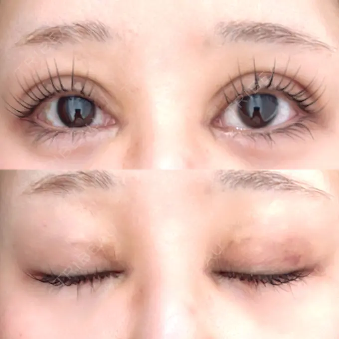 二重埋没 / 目頭切開 Brandnew Beauty Clinic DAY 10 メイン用