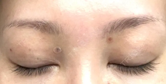 ピコレーザートーニング（美白・肝斑） / ピコスポット 日比谷セントラルクリニック DAY 4 メイン用