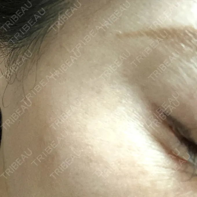 ボトックス（目尻） TCB東京中央美容外科 青森院 DAY 0 メイン用