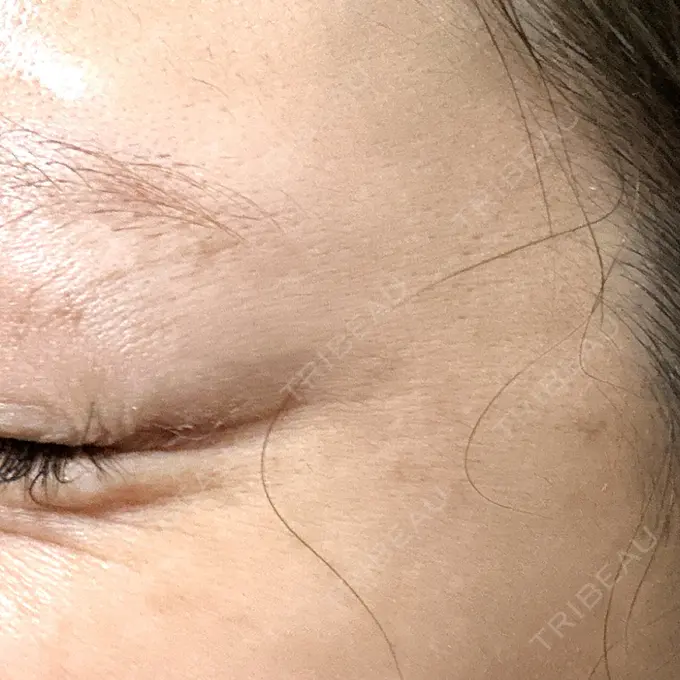 ボトックス（目尻） TCB東京中央美容外科 青森院 DAY 1 メイン用