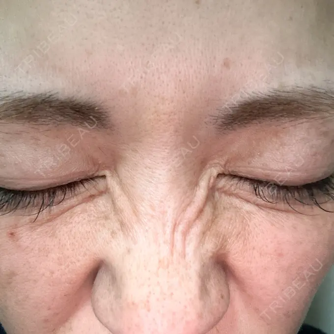 ボトックス（眉間） / その他（鼻） TCB東京中央美容外科 青森院 DAY 11 メイン用