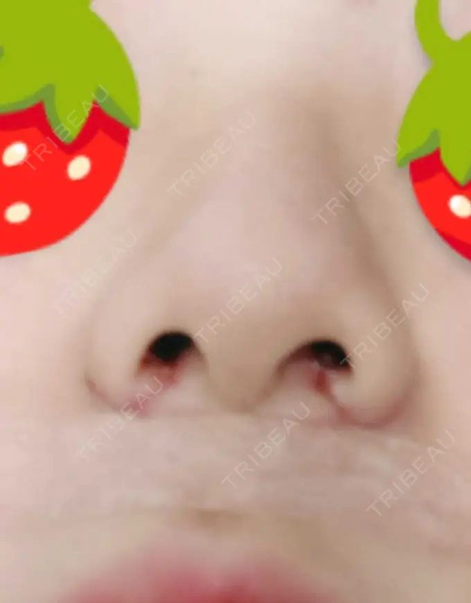 小鼻縮小（切開） 宇都宮ひふ科形成外科 DAY 7 メイン用