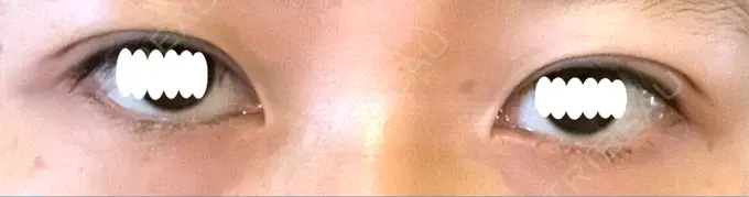 二重埋没 札幌ル・トロワ ビューティクリニックVogue DAY 2 メイン用