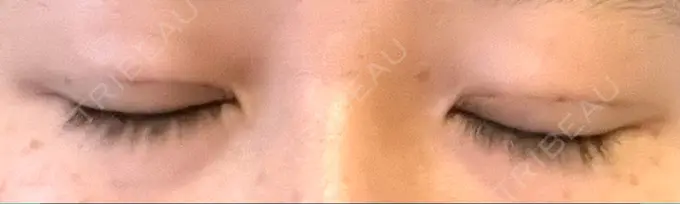 二重埋没 札幌ル・トロワ ビューティクリニックVogue DAY 2 メイン用