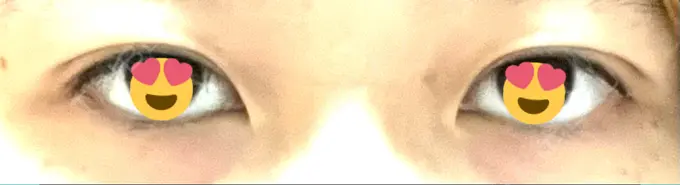 二重埋没 札幌ル・トロワ ビューティクリニックVogue DAY 3 メイン用