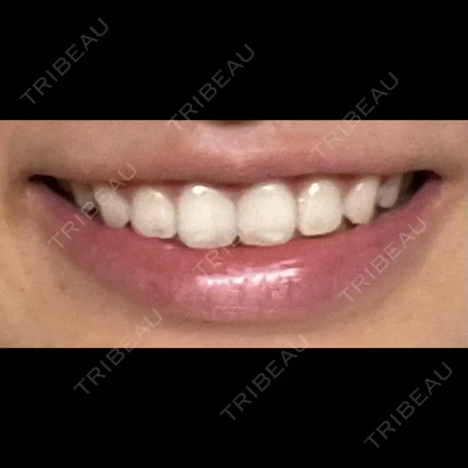 ホワイトニング SK新宿歌舞伎町美容外科・歯科 AFTER メイン用